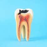 How Can Dental Services In Preventing Tooth Decay?